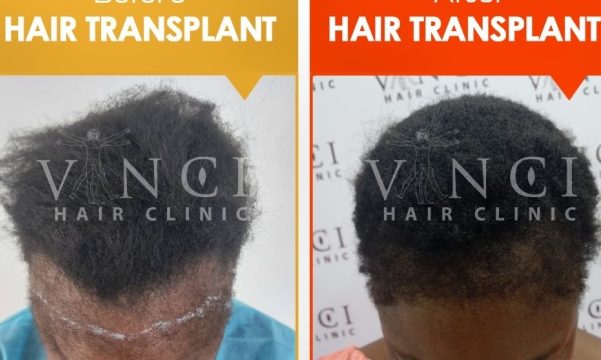Reveal Your Inner Confidence: A Guide to Effective Hair Loss Treatments for Women