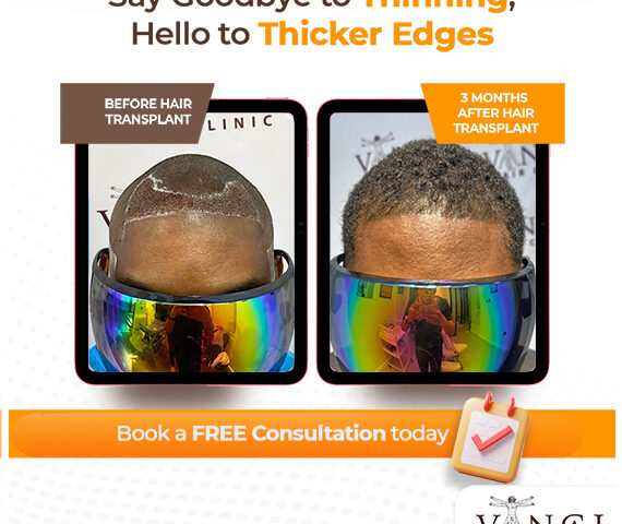 Vinci Hair Clinic Africa: Transformative Hair Restoration Right at Home in 2025
