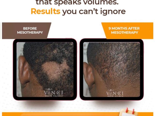 Thinning Hair Due to Stress? Mesotherapy Might Be Your Answer