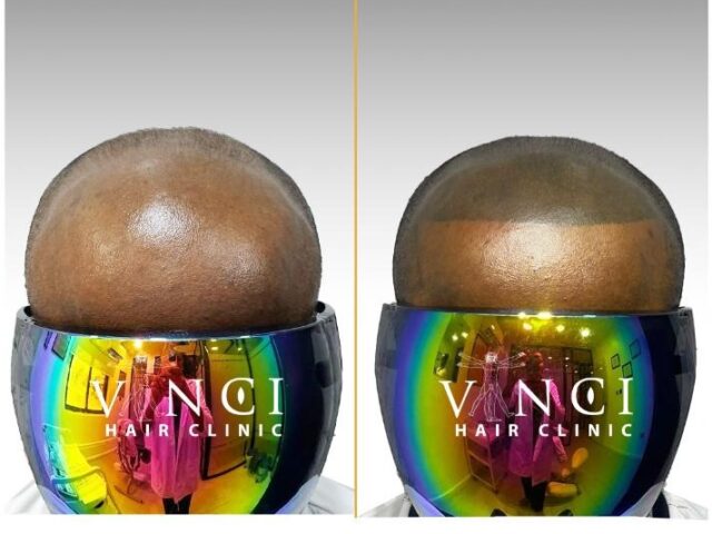 A Clean Hairline. Instant Results. No Surgery.